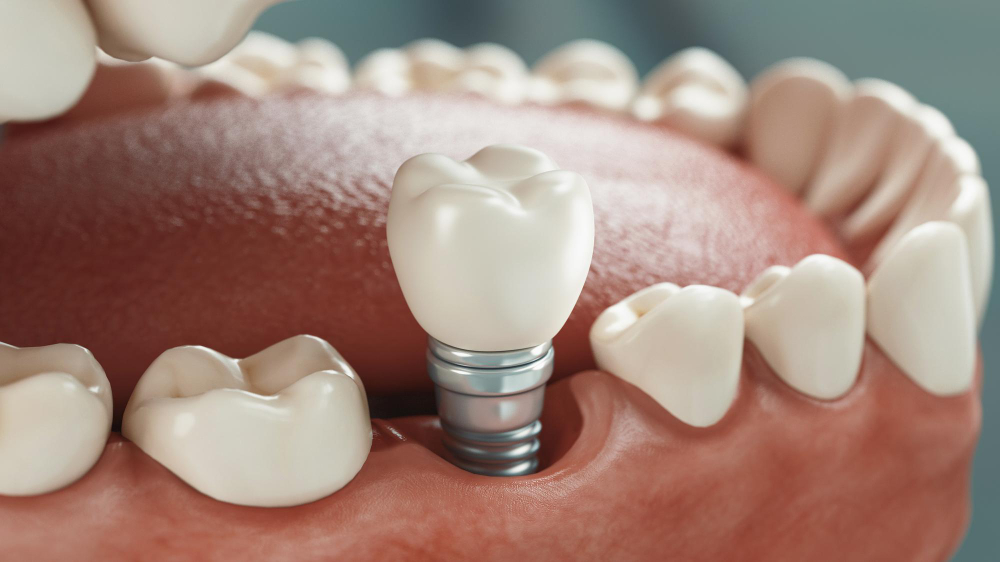 Dental Implants in Sugar Land